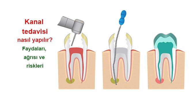 kanal tedavisi nasıl yapılır