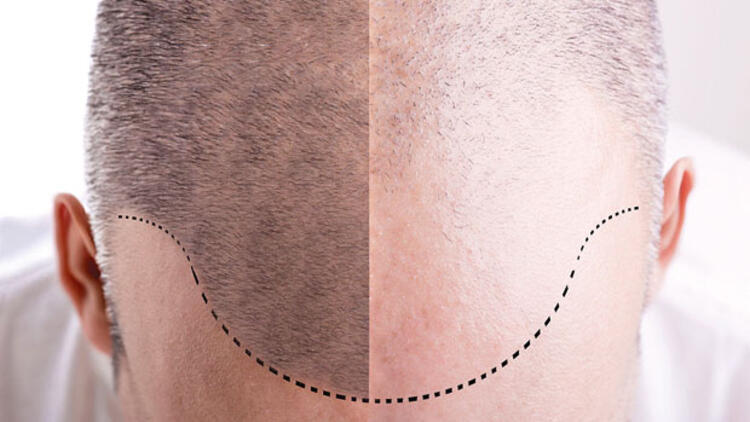 Saç Ekiminde Tercih Edilen Yöntemler