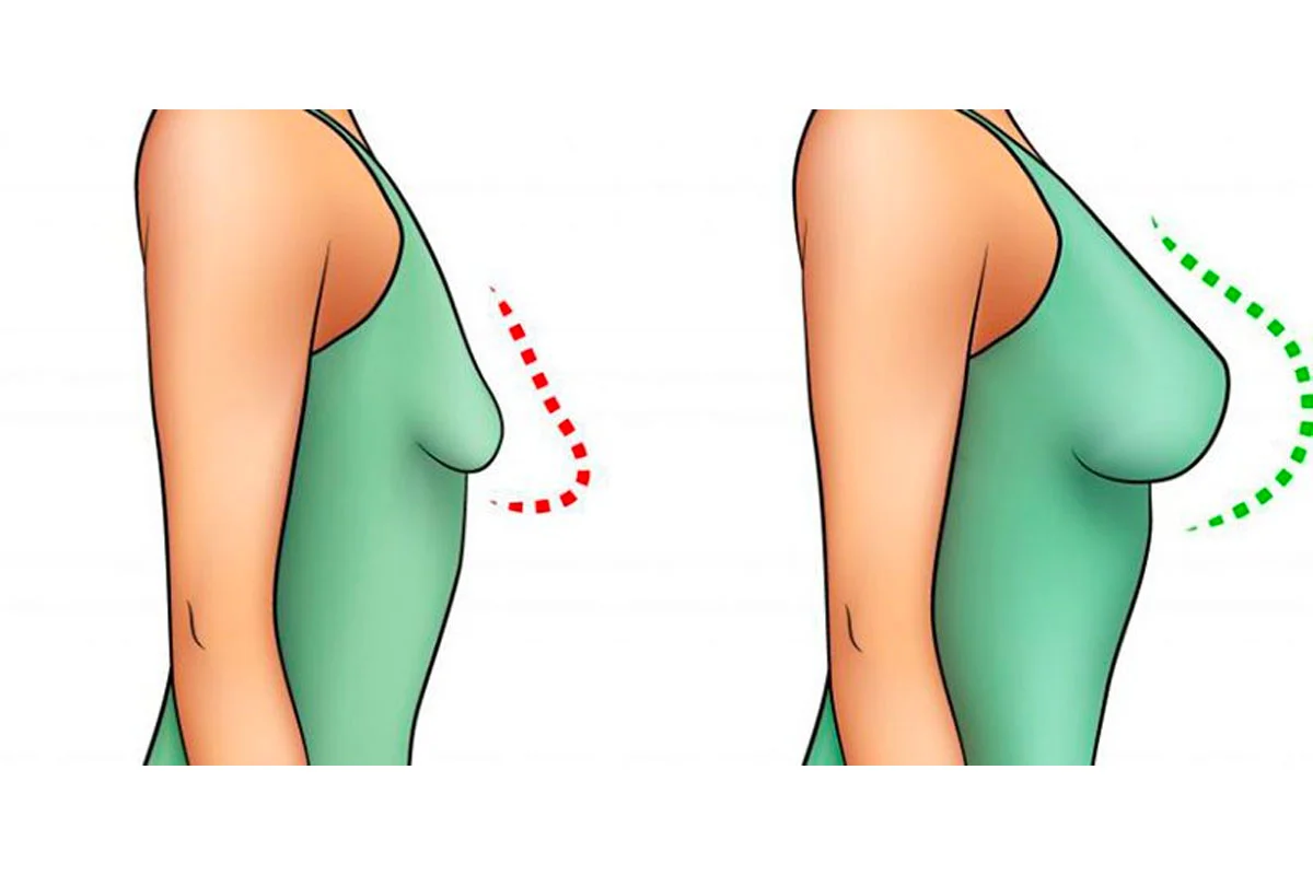 13 Soruda Meme Dikleştirme Toparlama Ameliyetı